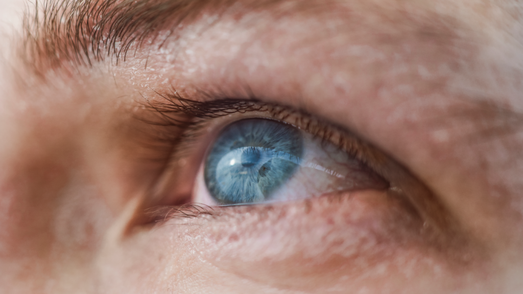 Mulher idosa com a visão embaçada pela catarata