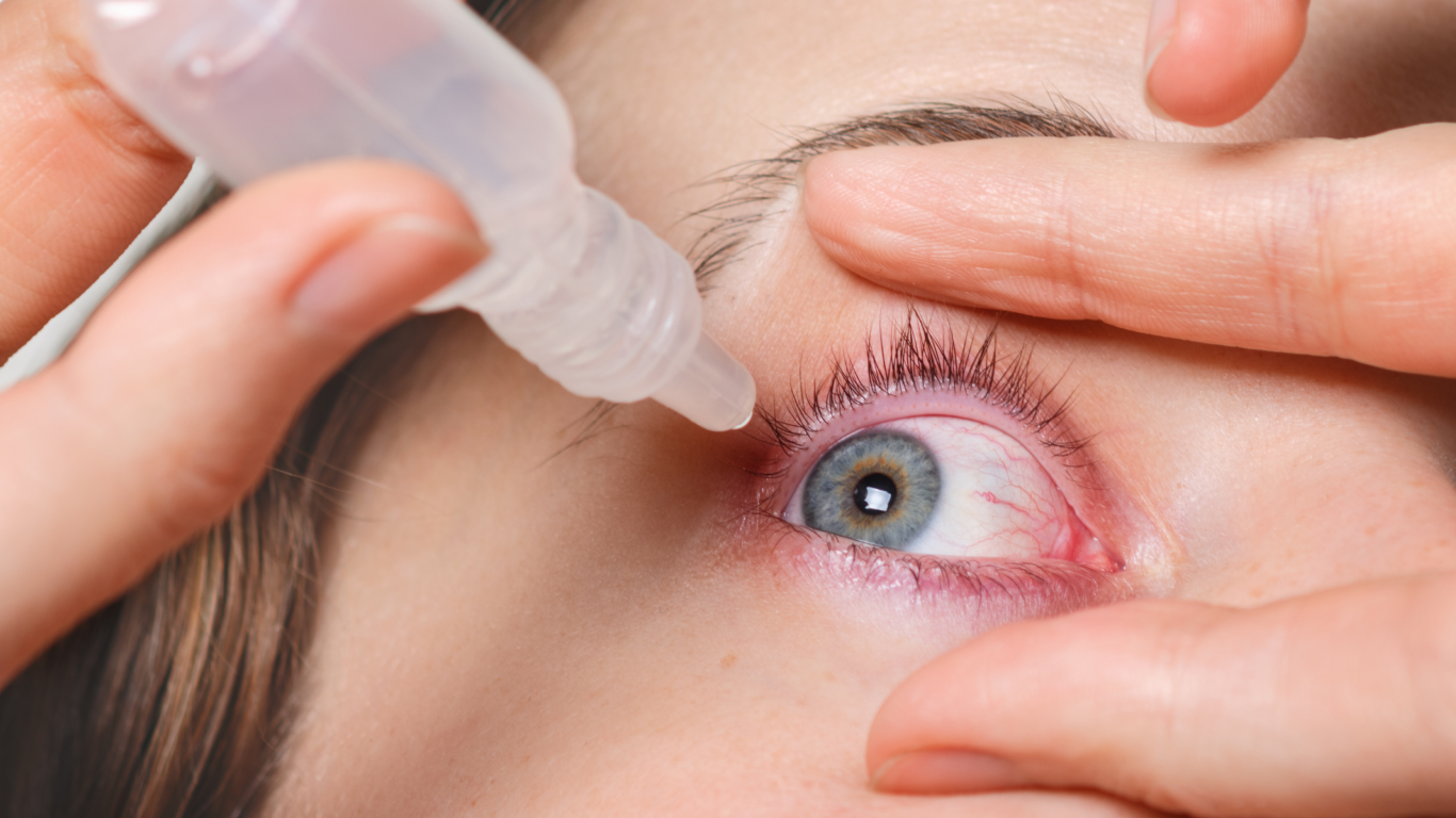 Mulher pingando colírio no olho direito, para falar sobre o glaucoma sem sintomas